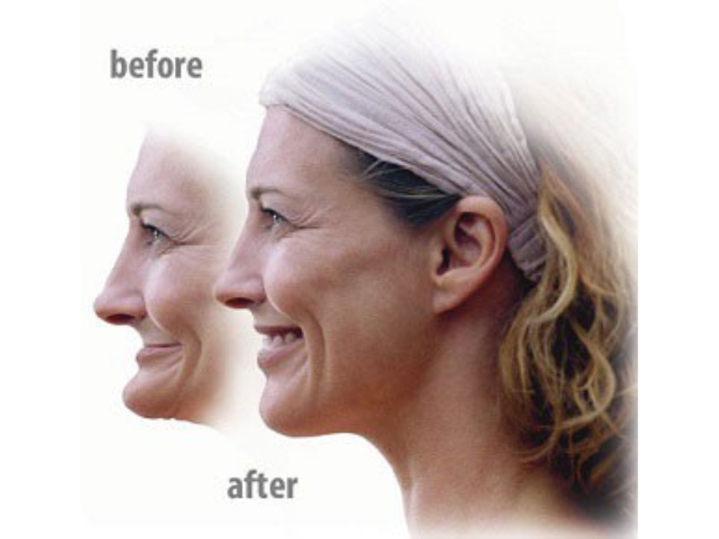 Orthodontic Braces