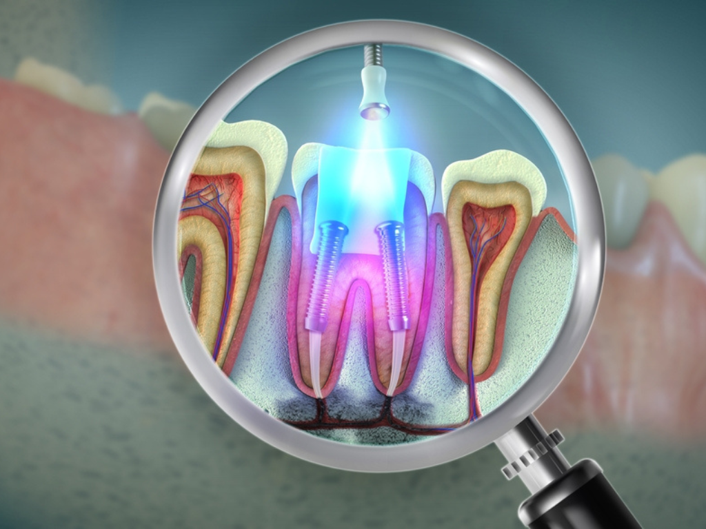 Orthodontic Braces