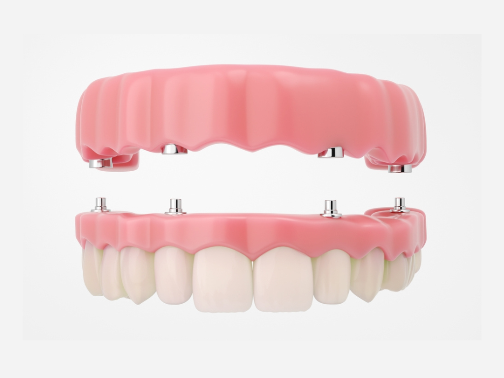 Orthodontic Braces