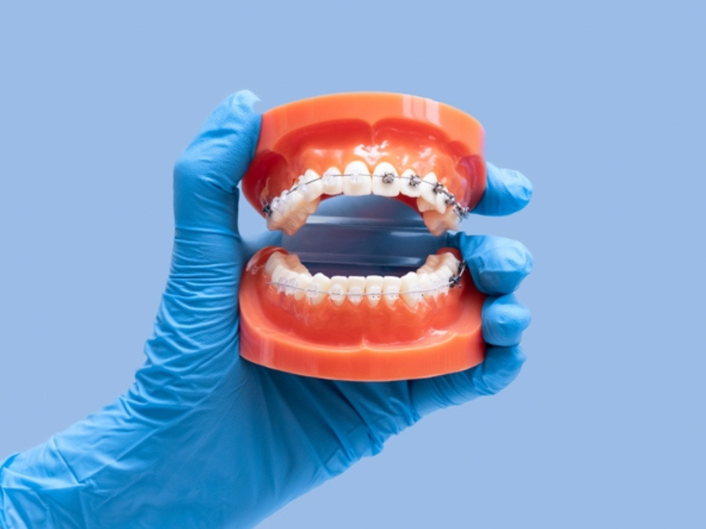 Orthodontic Braces