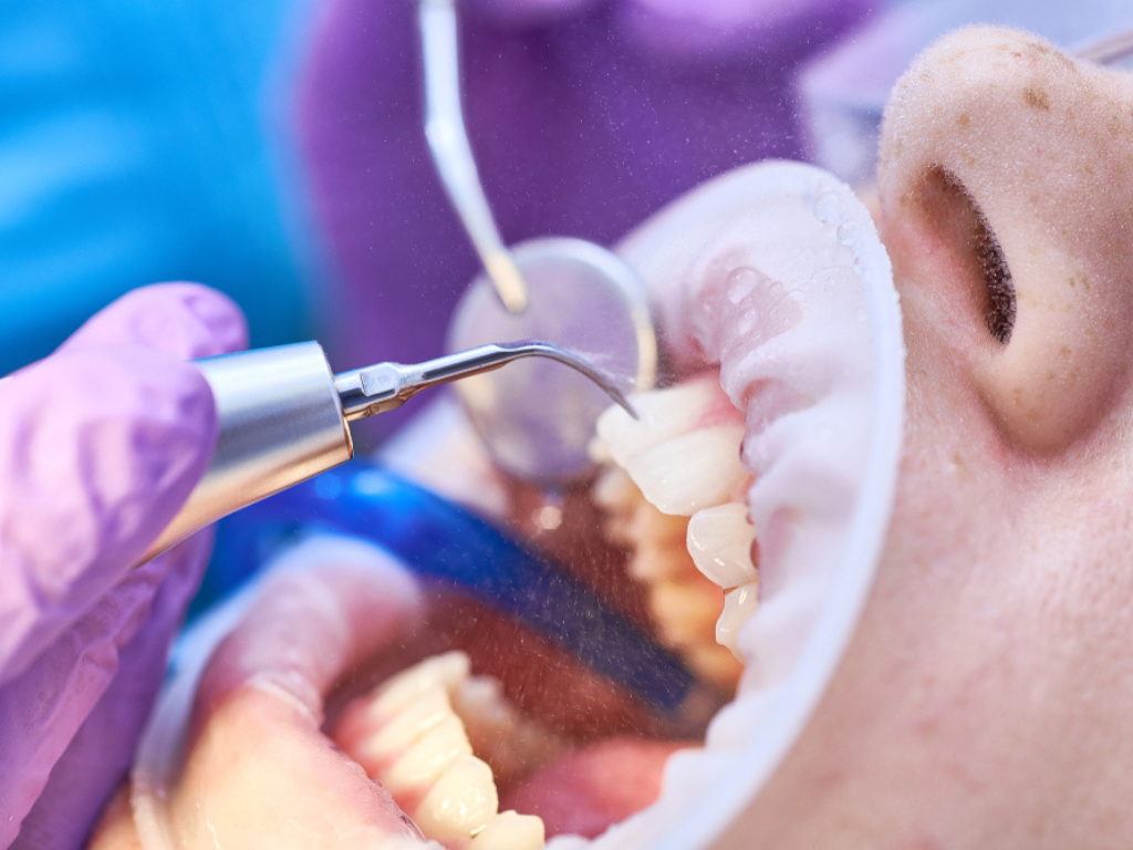 Orthodontic Braces