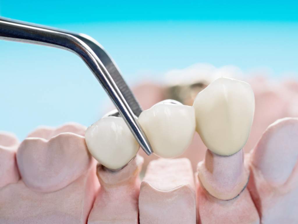 Orthodontic Braces