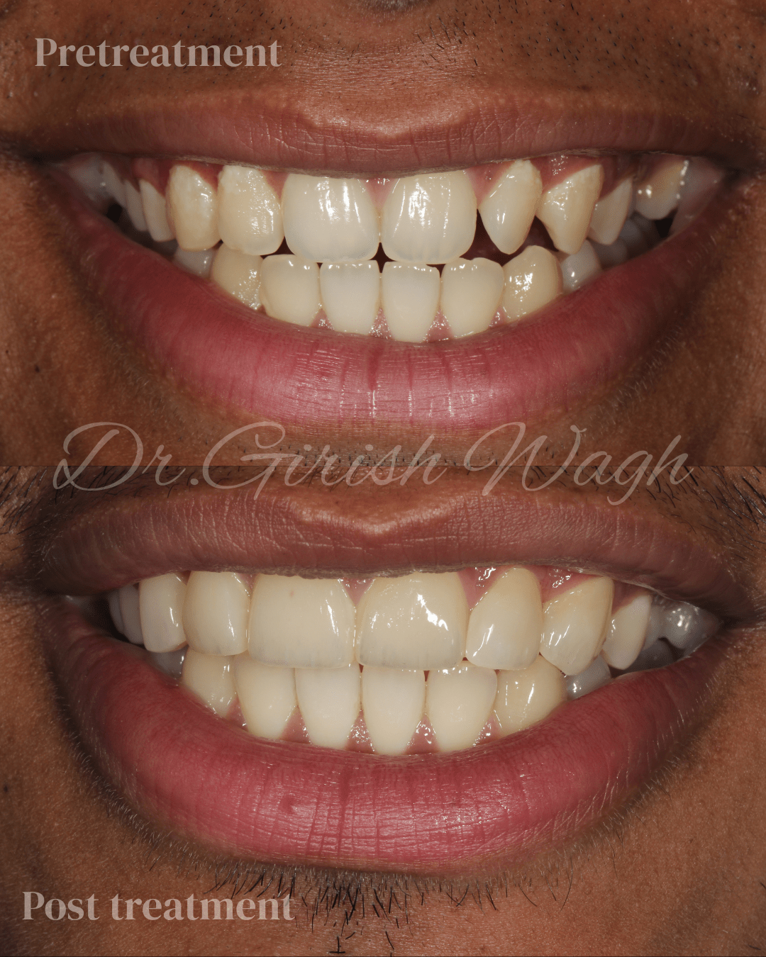 Ceramic veneers