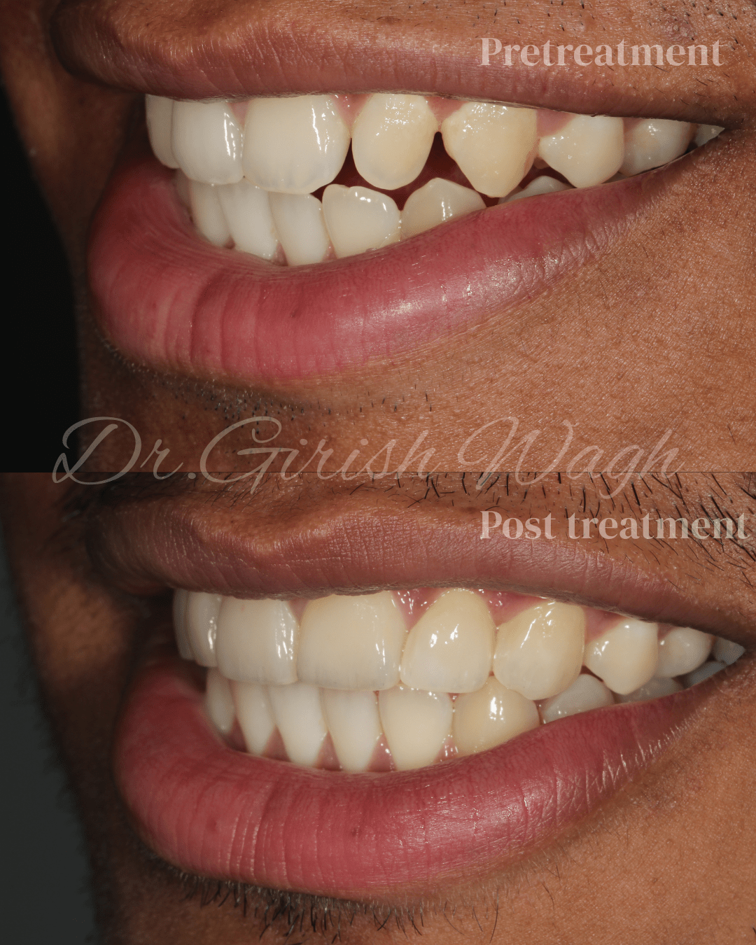 Ceramic veneers