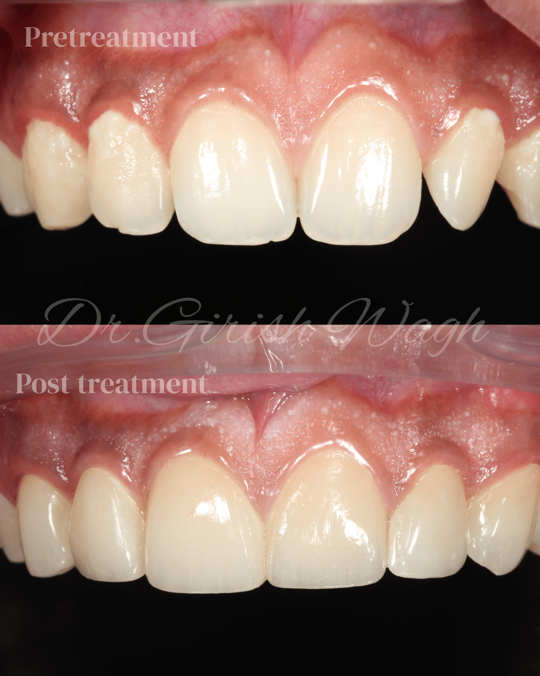 Ceramic veneers