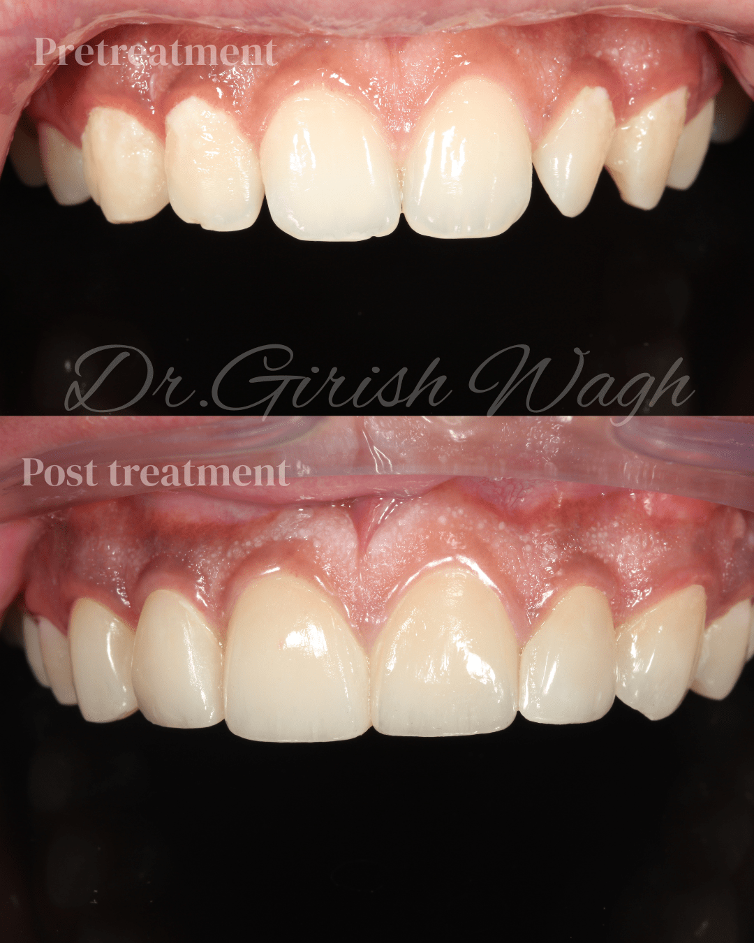 Ceramic veneers