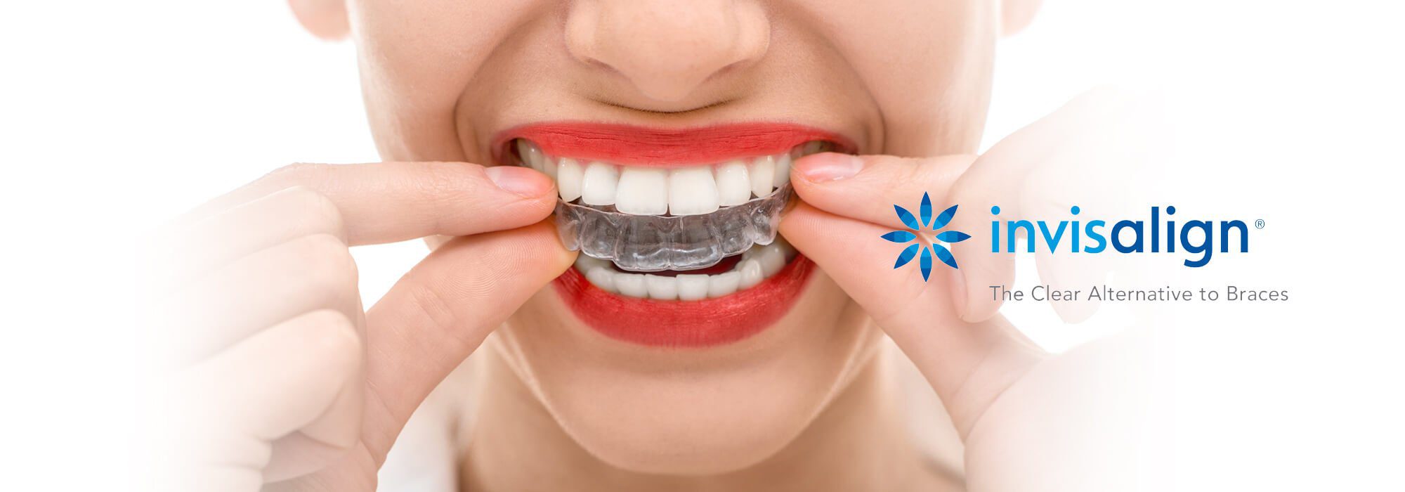 Invisalign Cost