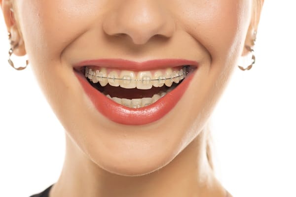 Invisible Braces